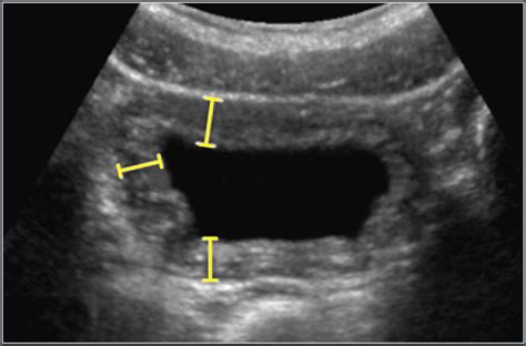 normal bladder wall thickness ultrasound